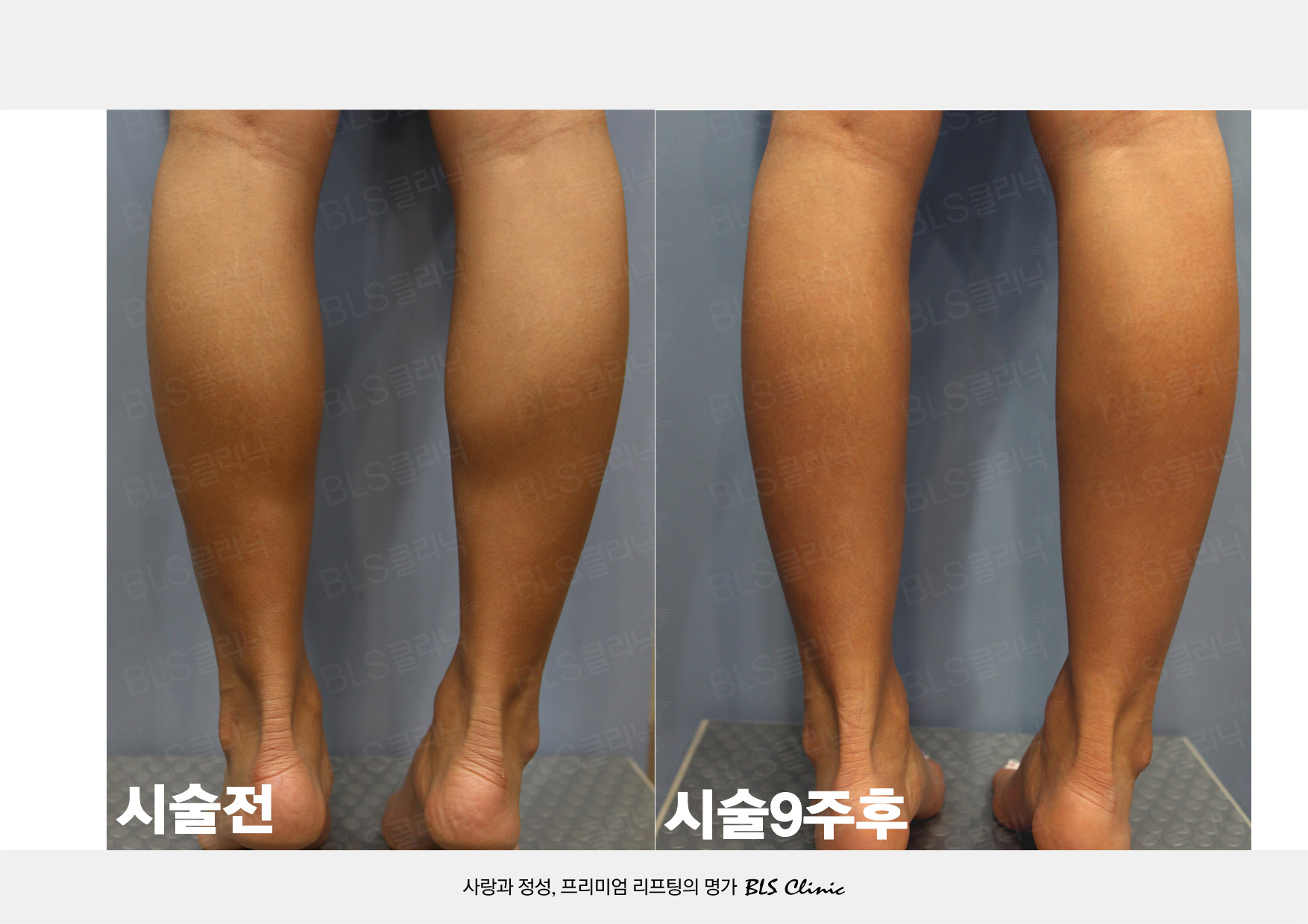 보톡스 시술전후