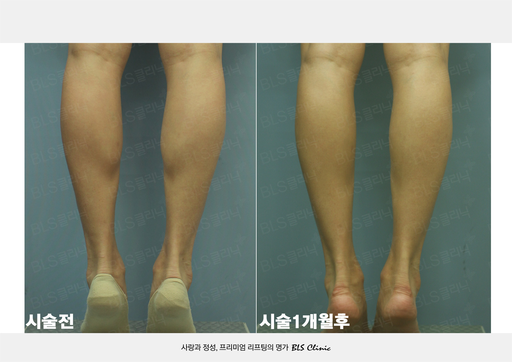 보톡스 시술전후